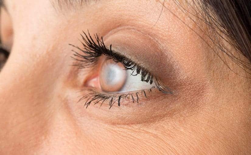 Cataract FAQs Atlanta, GA